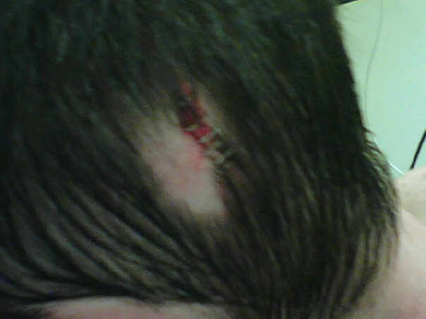 Close-up of a stitched wound on a person's head.