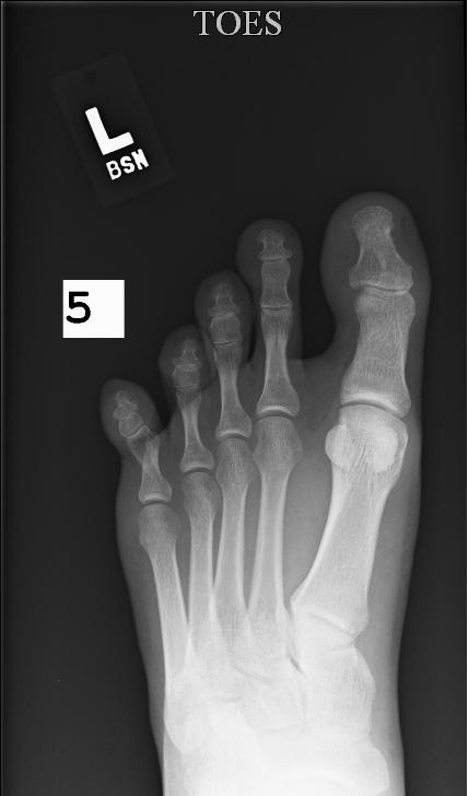 1948 Jeep Wrangler - Radiograph displays the bones of a human foot, including toes and metatarsals, with identifying markers.