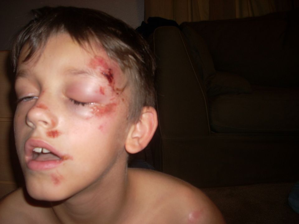 Child with bruised eye and cuts on face