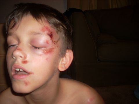 1992 Ford Bronco - Child with facial injuries, including a swollen eye and cuts on the forehead and nose.