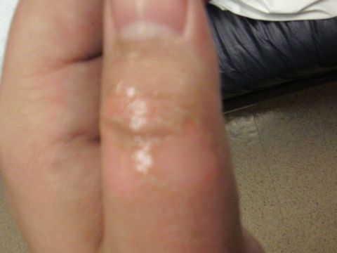 1996 Ford Bronco - A blister is visible on a person's finger.
