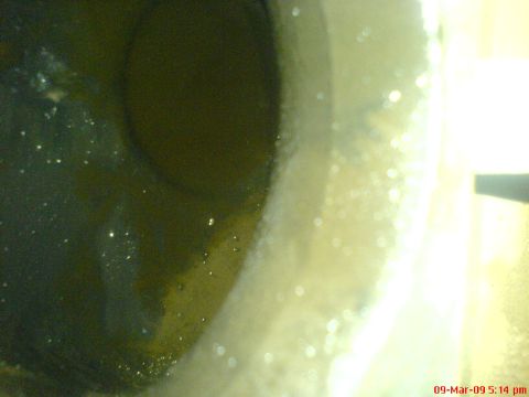 1992 Ford Crown Victoria - This is a close-up view of an engine intake valve, showing significant carbon deposits.