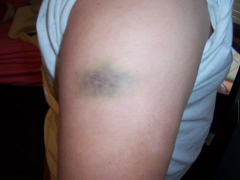 1979 Ford Bronco - A bruise is visible on a person's arm, with a white shirt in the background.