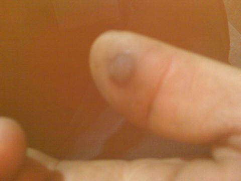 1995 Ford Bronco - A close-up view of a finger with a noticeable bruise on the nail.