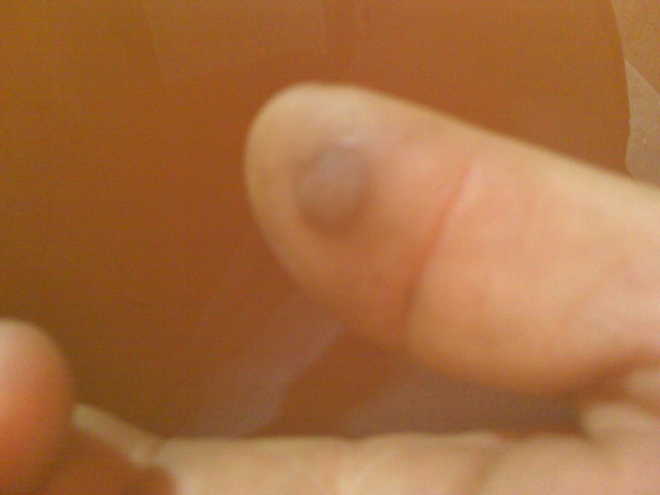 Finger with a dark bruise on the nail