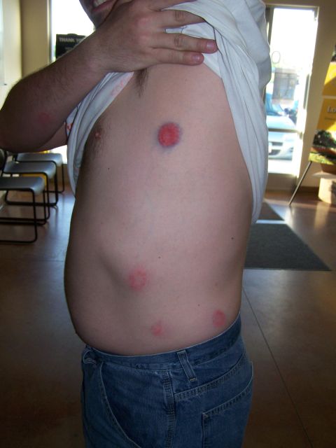 1986 Ford Bronco - Person displays red marks on their torso, possibly from an injury or medical treatment.
