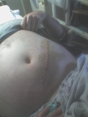 1993 Ford Bronco - A close-up view of an abdomen showing a surgical scar and stitches, with the Supermotors.net logo in the lower right corner.