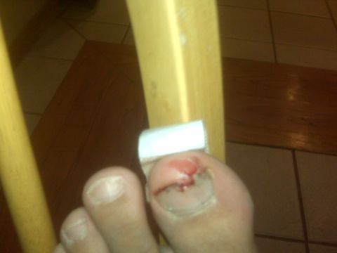 1985 Ford Bronco - A close-up view of an injured toe, with a bandaged toenail, against a blurred background of wooden furniture and tiled flooring.