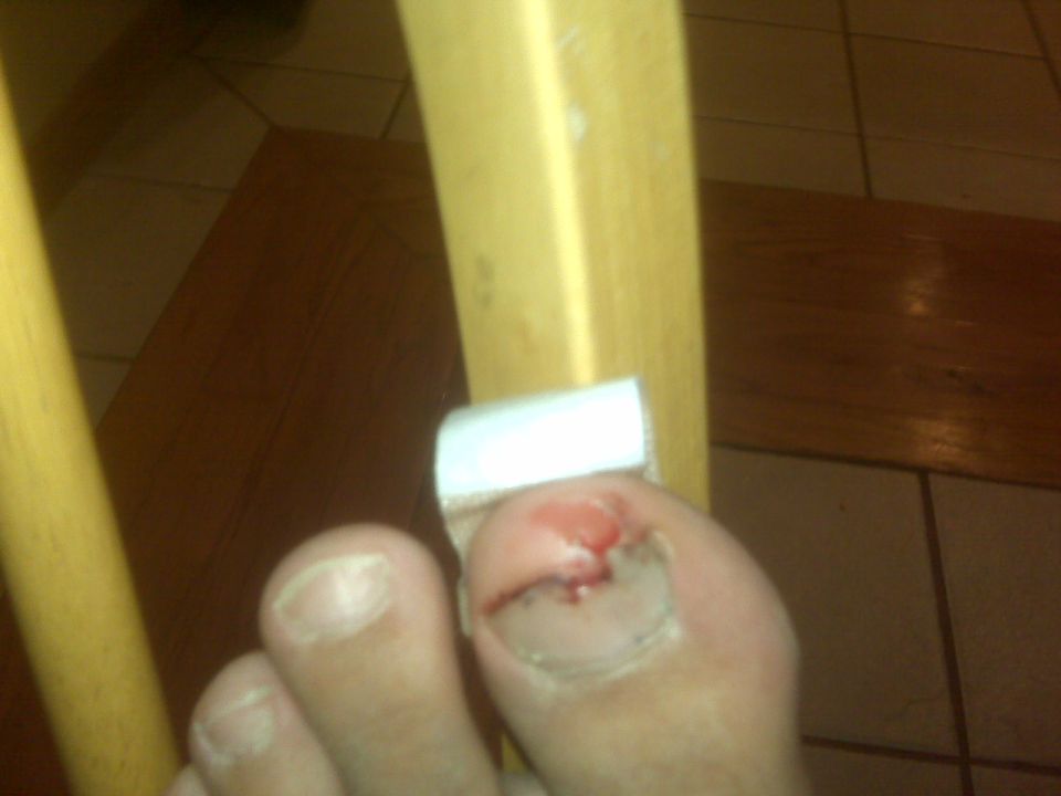 Close-up of an injured toe with a bandaged toenail, resting on a wooden chair leg