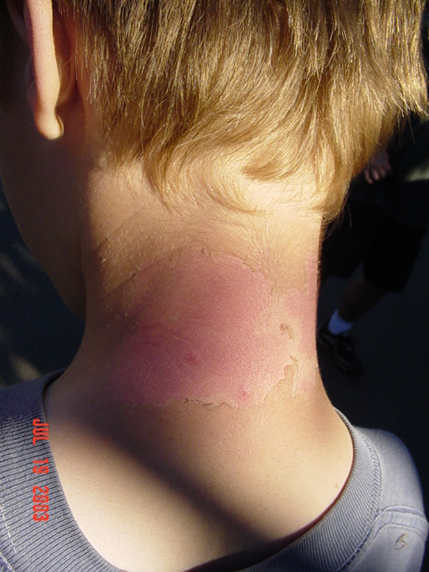 1989 Ford Bronco - Sunburn on neck with peeling skin, dated July 19, 2003.