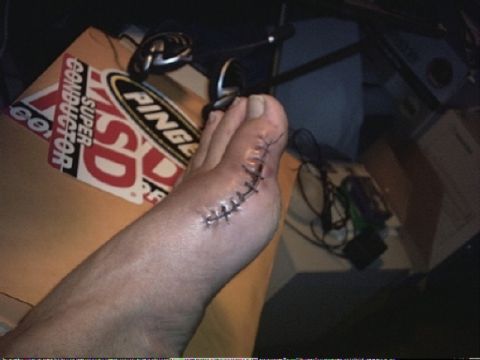 1999 Kawasaki H2C - A foot with surgical stitches is shown, with various stickers and wires in the background.