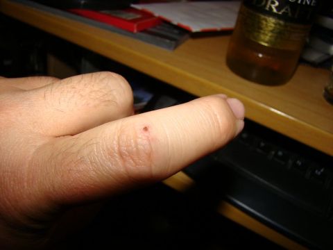1989 Ford Bronco - A close-up view of a thumb showing a small wound or mark on the side of the finger.