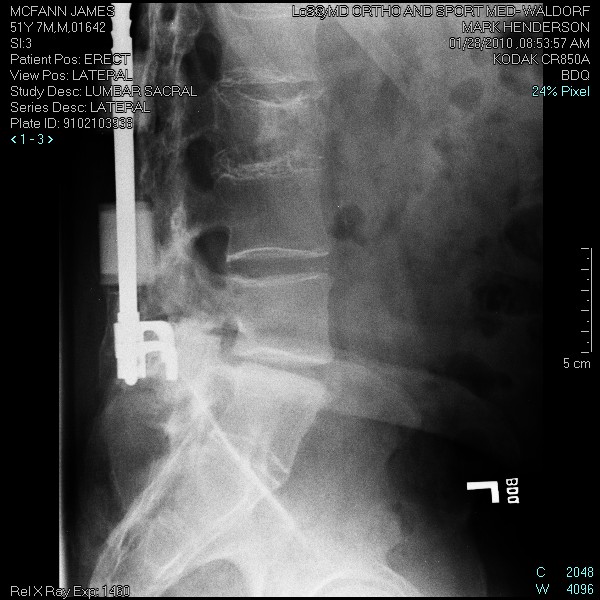 Medical X-ray of lumbar spine with surgical hardware