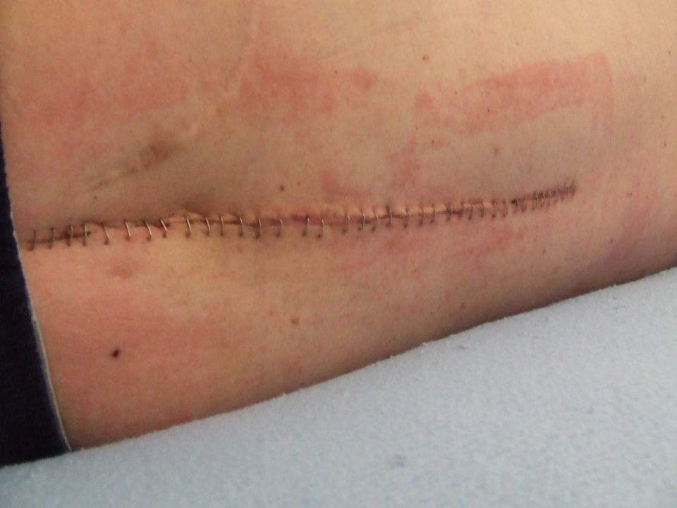 Close-up of a surgical incision closed with staples on skin
