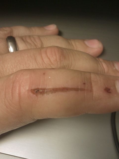 1996 Ford Bronco - Only injury of the weekend. this is why you should wear leather gloves when using a grinder with no guard.
