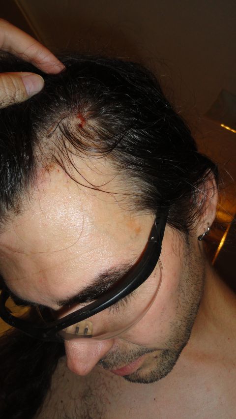 1989 Ford Bronco - The hood fell down, hit me in the back of the head and smashed my head into the waterpump. Was bleeding a bit, and scuffed me up in 3 place…