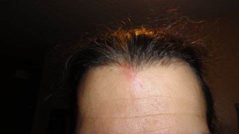 1989 Ford Bronco - Close-up of a person's forehead and hairline showing a small red scrape or cut at the hairline.