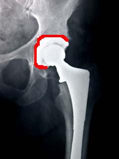 1981 Ford Bronco - This X-ray shows a hip replacement implant, not a 1981 Ford Bronco.