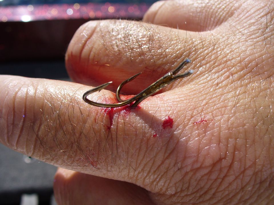 Treble fishing hook embedded in skin of a bloody hand