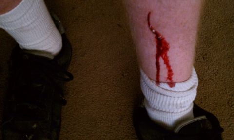 1990 Ford Bronco - A person's leg shows a bleeding wound above their sock and shoe, with a website watermark at the bottom.