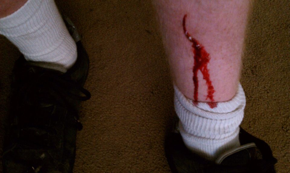 Close-up of a bloody gash on a person's lower leg, above a white sock and black shoe