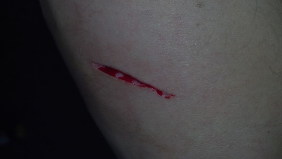 A cut on an arm with visible blood.