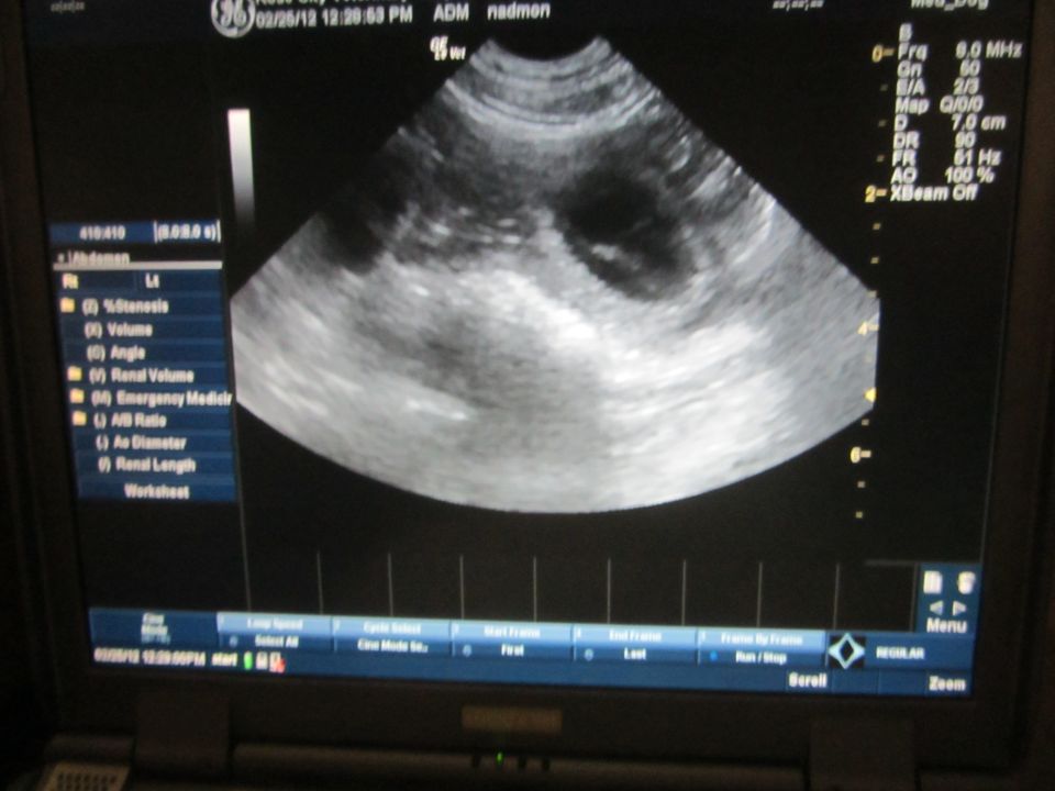 Photo of a medical ultrasound monitor displaying a grayscale sonogram scan