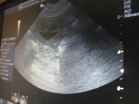 1968 Ford Mustang - This is an ultrasound image displaying internal body structures, not a vehicle.