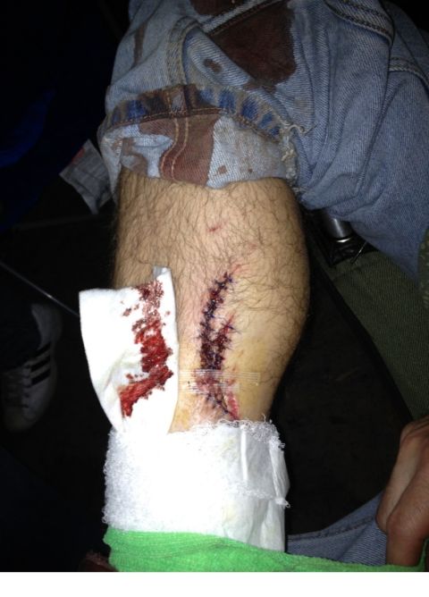 1992 Ford Bronco - this is what happens when you're not careful with a chainsaw. my calf caught the tip of a 20 inch bar while I was limbing a tree. 20 stitch…