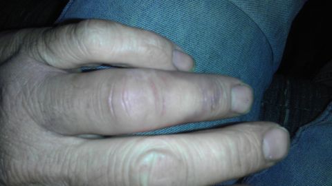 1989 Ford Bronco - This image shows a hand with visible scrapes and bruising on the knuckles and fingers.