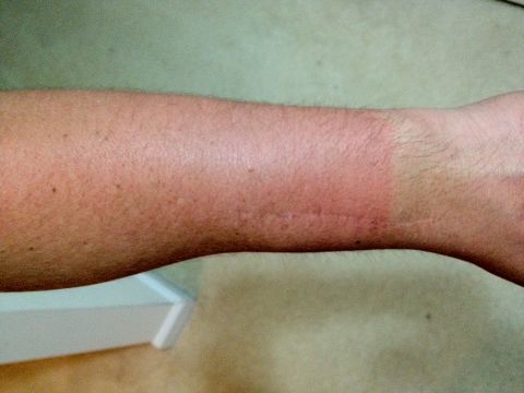 1989 Ford Bronco - A close-up view of a human arm with a visible scar on the wrist, against a blurred background.