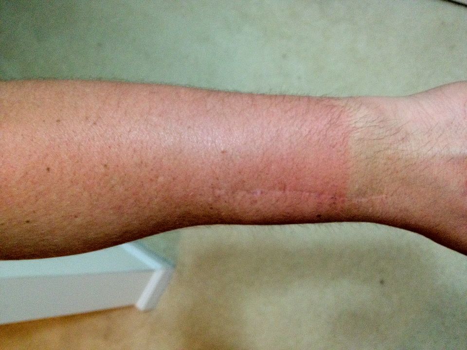 Human arm with a scar across the wrist, showing skin texture and a white object in the background