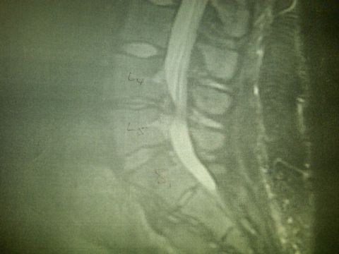 1979 Ford F-150 - This is an MRI of the lumbar spine, showing vertebrae L4, L5, and S1.