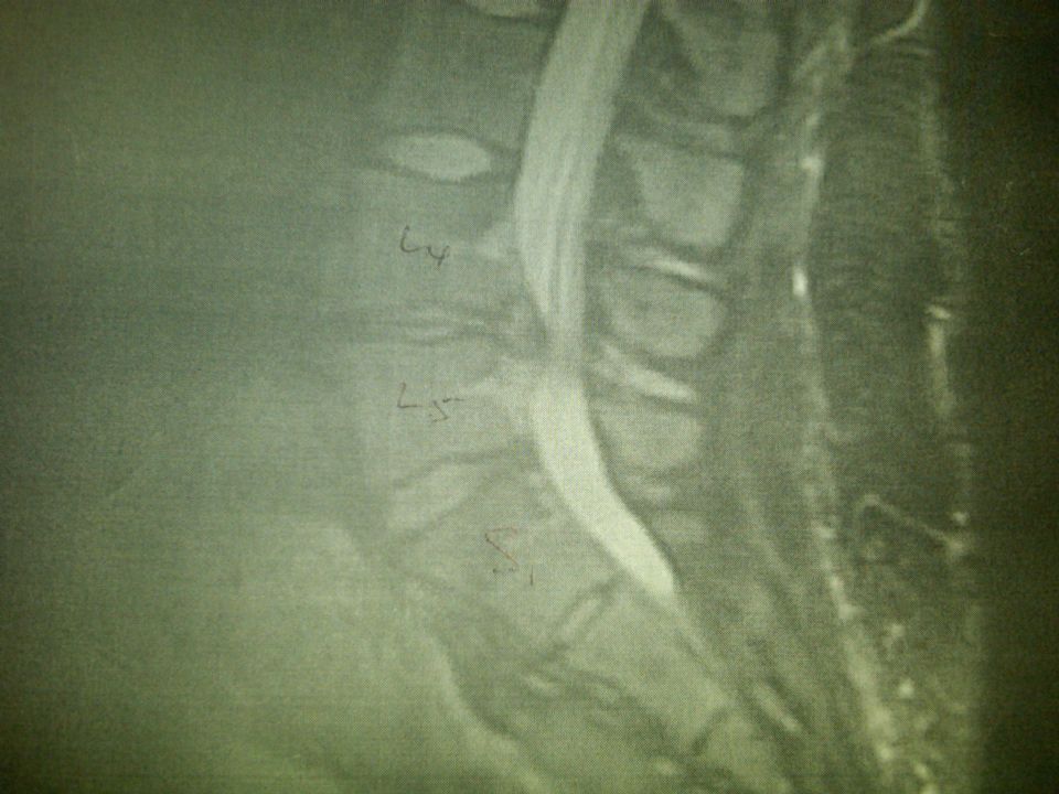 MRI scan showing lumbar vertebrae L4, L5, and S1