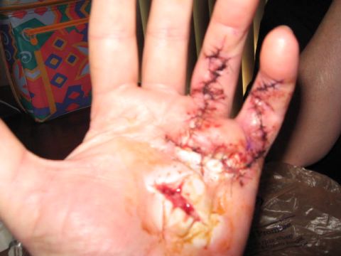 1963 Ford Galaxie - Hand injury requiring multiple stitches and medical attention.