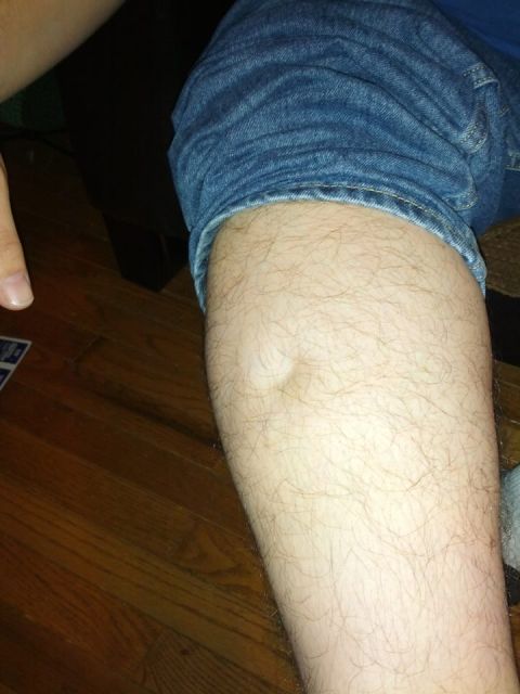 1979 Ford F-150 - A close-up view of a human leg showing a noticeable lump on the calf, with blue denim jeans visible.