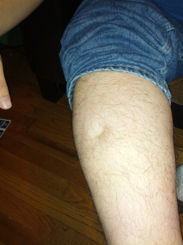 Human leg with a lump on the calf, wearing blue jeans, against a wooden floor