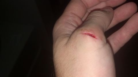 1995 Ford Bronco - A cut on the back of a hand is shown with blood welling up.